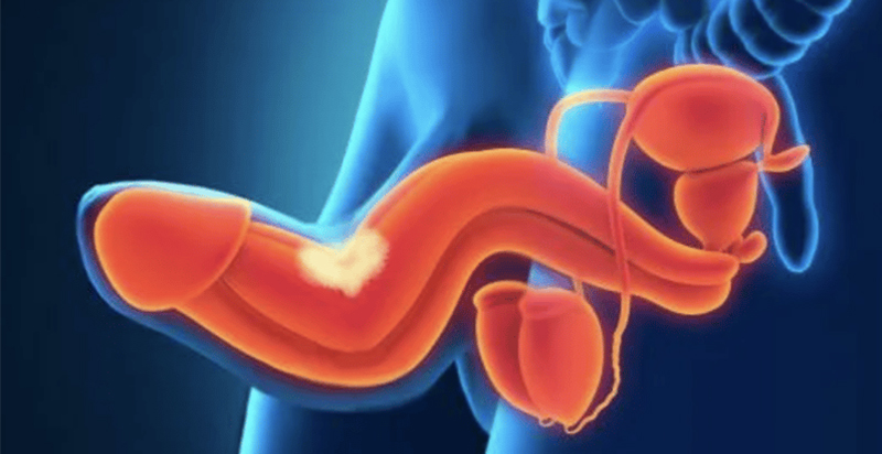 Penis Uzatma ve Kalınlaştırma Ameliyatları